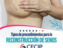 Tipos de procedimiento para la reconstrucción de senos